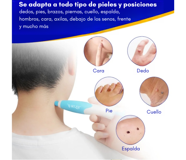 Wartzer™ ¡Adiós a las verrguas! - ¡Facíl, rápido e indoloro!